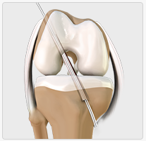 ACL Reconstruction